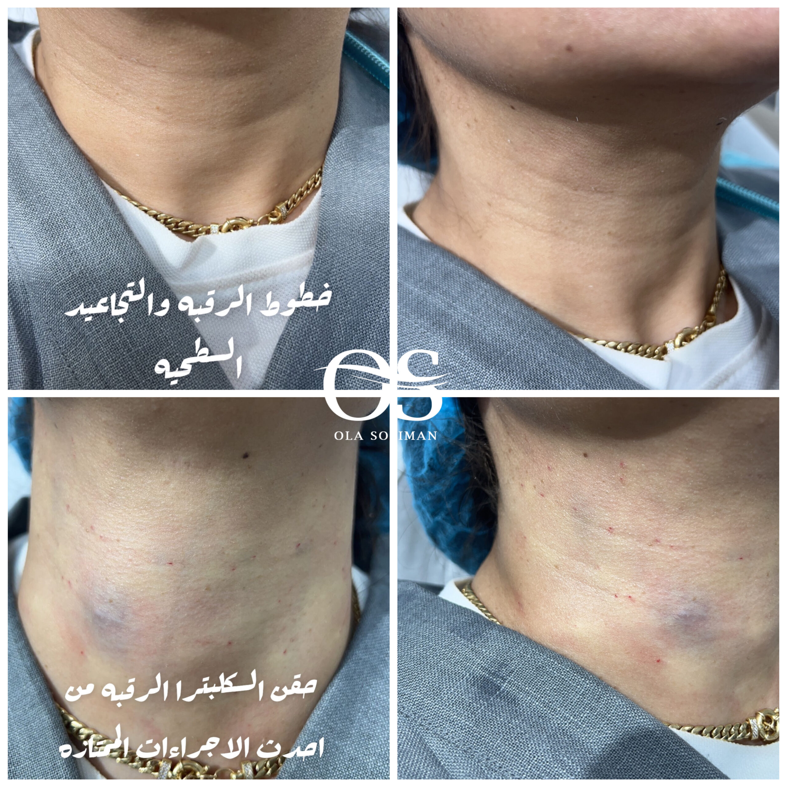 Neck injections 8