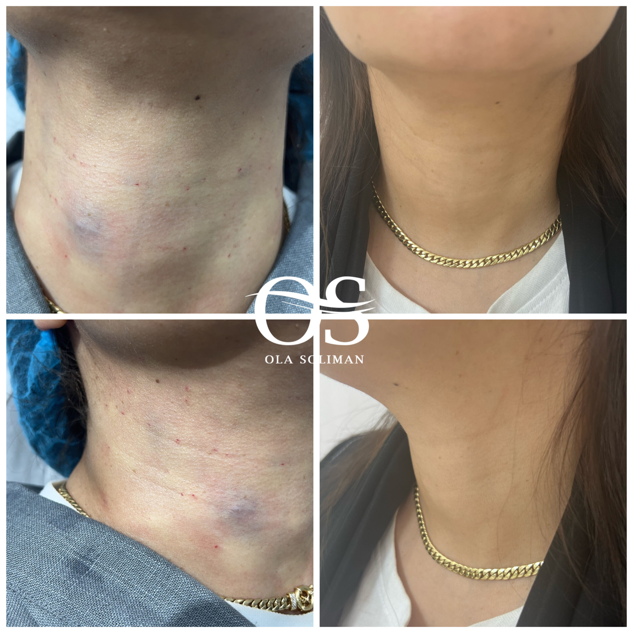 Neck lift 15